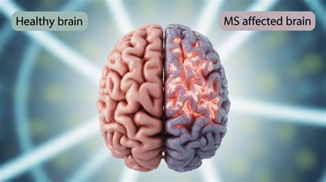 normal brain vs ms brain