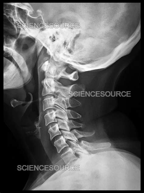 Normal Cervical Spine X-Ray Guide: Quick Insights