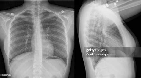 Normal Chest X Ray 2 Year Old