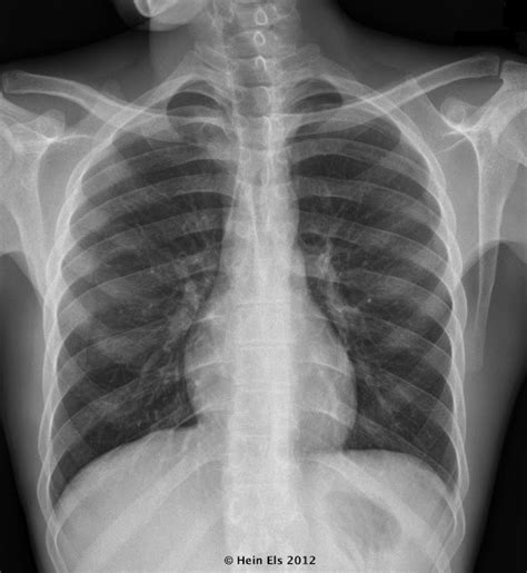 5 Tips Normal CXR