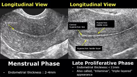 normal endometrial thickness on ultrasound