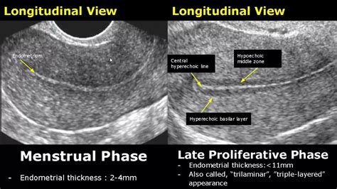 normal endometrium measurement ultrasound