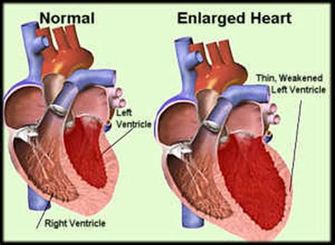 normal heart vs enlarged heart picture