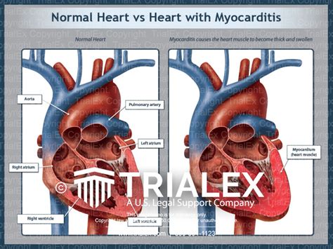 normal heart vs myocarditis