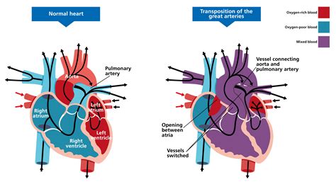 normal heart vs tga