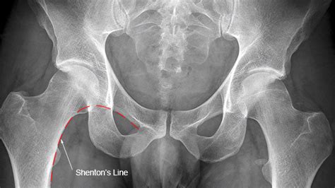 Normal Hip X Ray Insights: Uncovering What a Healthy Scan Looks Like