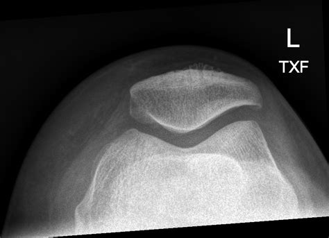 normal knee x-ray patellofemoral