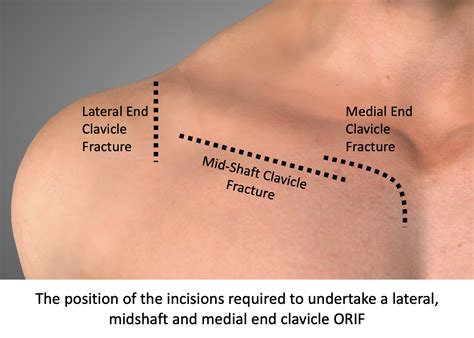 normal length of clavicle