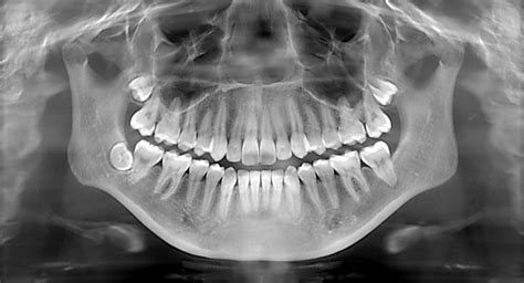 Normal Mouth Xray