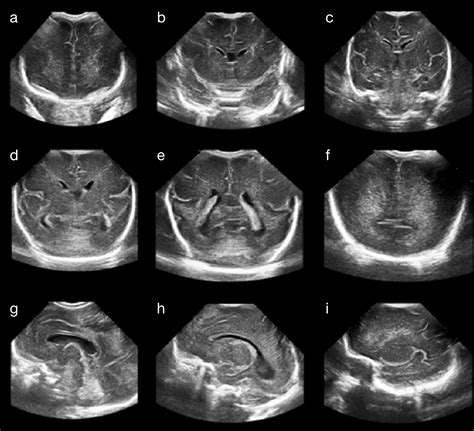 normal neonatal head ultrasound images