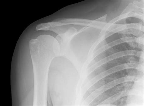 Normal Shoulder X-Ray Insights Unveiled