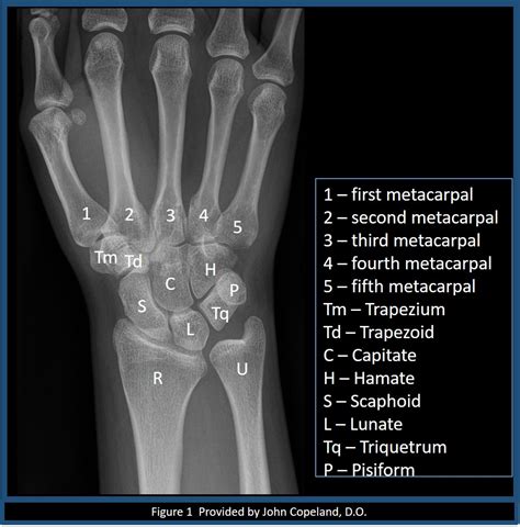 Normal Wrist X-Ray Labeled