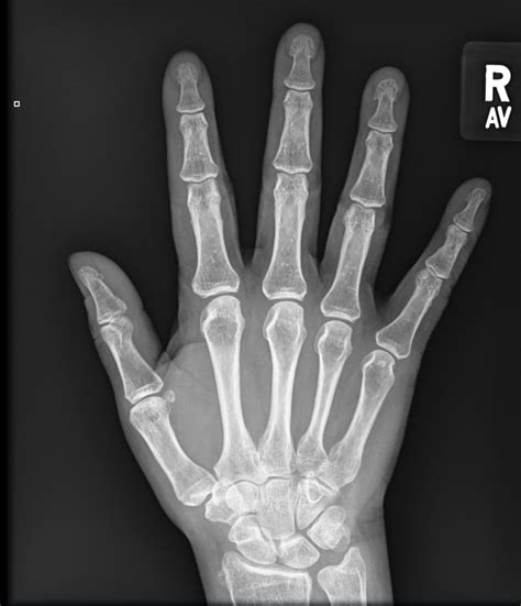 Normal X-ray Hand Insight Under 10 Words