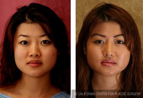 Before and After Non Surgical Rhinoplasty (Frontal view) Beverly