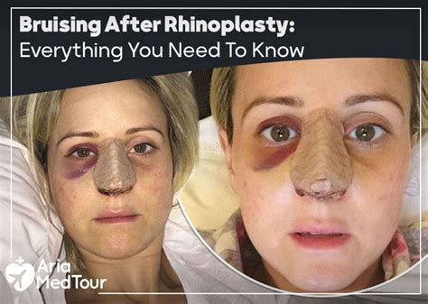 My Rhinoplasty Recovery Before and After Pictures Day 5