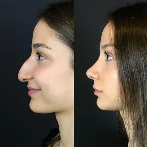 How Much Does A Nose Job Cost In Texas Job Drop