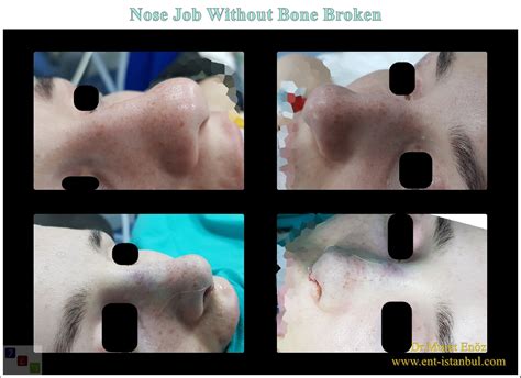 Nose Job Without Breaking Bone
