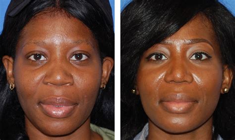 Nose Plastic Surgery Less Wide