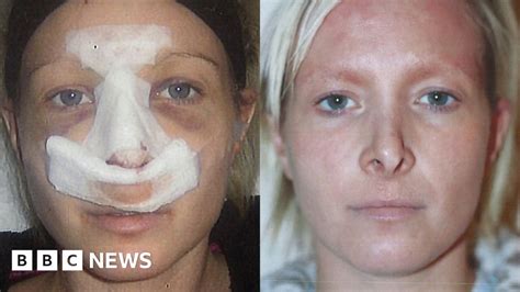 Nose Surgery Gone Wrong: Shocking Lessons From Real Stories