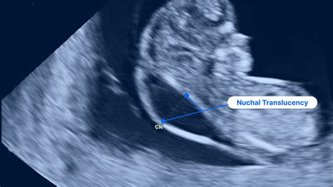 Understanding Nuchal Translucency Screening: What to Expect During Pregnancy