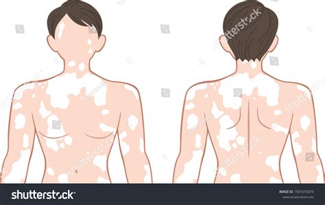 nudes vitiligo