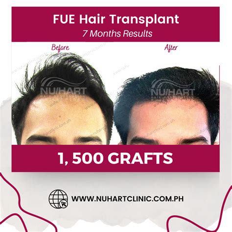 Photo gallery of Nuhart Hair Restoration Philippines medical centers