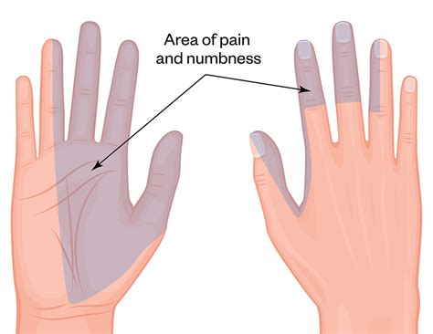 Understanding Numbness in Thumb: Causes, Symptoms, and Effective Treatments