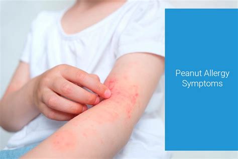 Don't Crack Under the Pressure: Common Nut Allergy Symptoms You Should Know