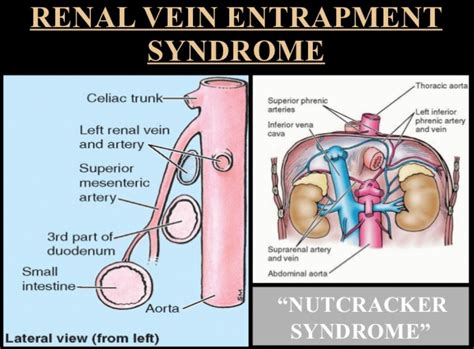 Nutcracker Syndrome Untreated
