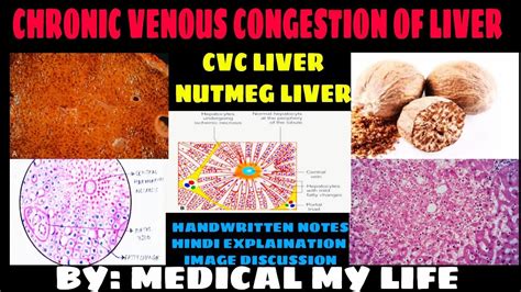 Nutmeg Liver Cvc