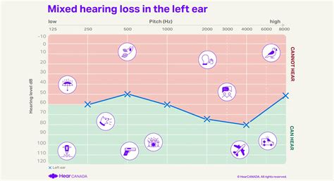 O Mixed Hearing Loss