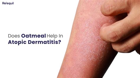 Oatmeal Atopic Dermatitis