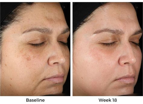 obagi skin care reviews before and after