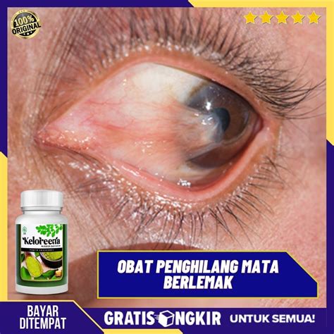 obat herbal klw mata merah