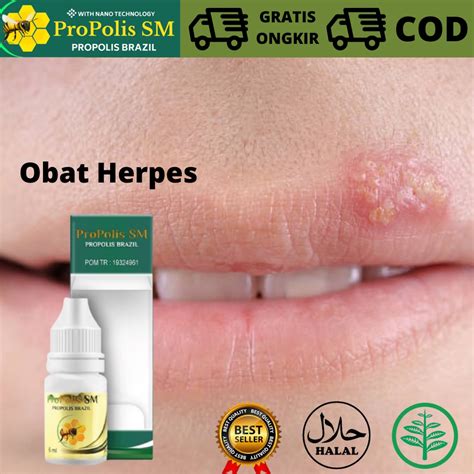 obat herbal untuk herpes kulit