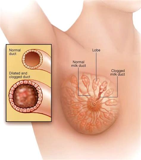 Relieving Pain: What Causes an Obstructed Milk Duct?
