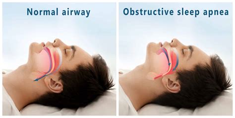 obstructive sleep apnea adult