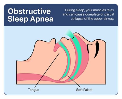 obstructive sleep apnea anatomy