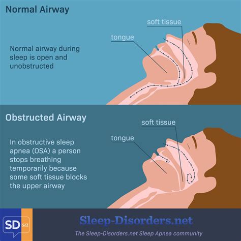 obstructive sleep apnea diagram