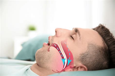 obstructive sleep apnea disorder