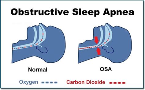 obstructive sleep apnea hypopnea syndrome