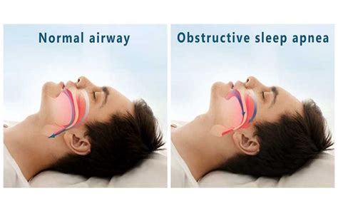 obstructive sleep apnea means