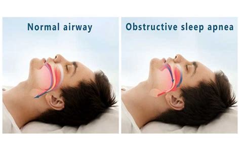 obstructive sleep apnea quiz