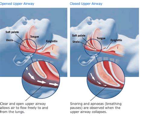obstructive sleep apnea syndrome adalah
