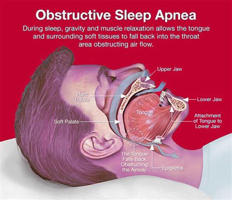 obstructive sleep apnea syndrome osas