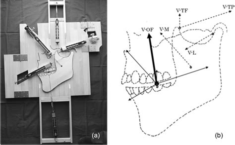 Occlusal Force Equilibration