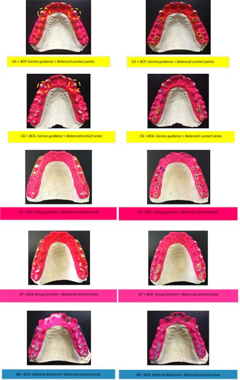 Occlusal Loads During Sleep