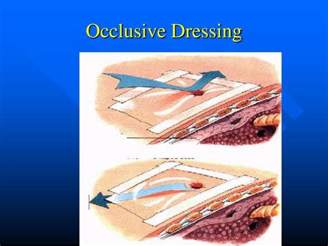 Occlusive Vs Pressure Dressing