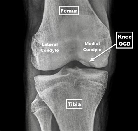 ocd lesion knee icd 10