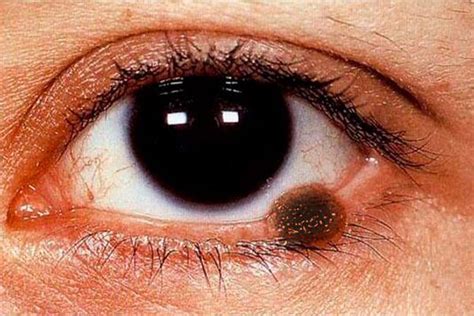 ocular melanoma and skin melanoma